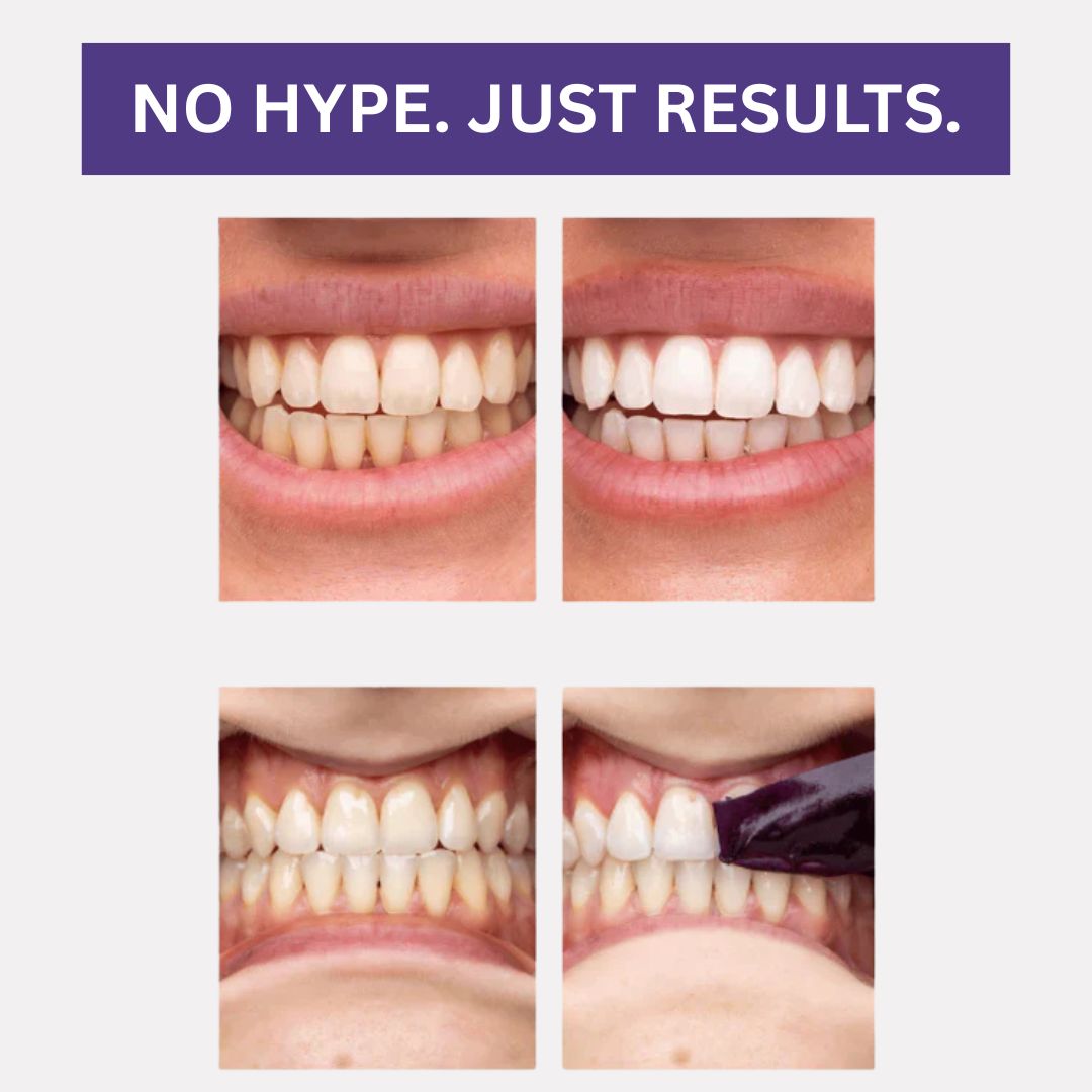 V34 Teeth Whitening Strips (PAP+ Formula)